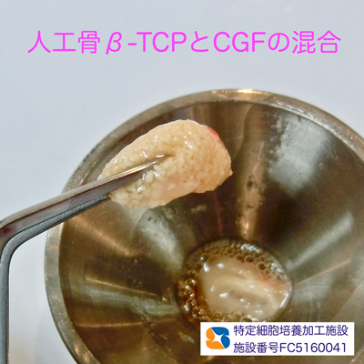 安心　安全　無添加の自己血液由来　フィブリノーゲン