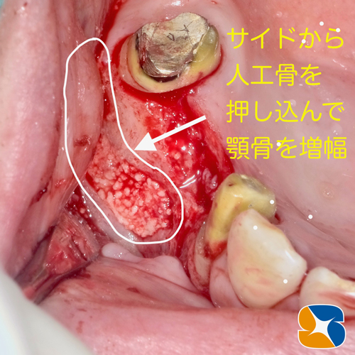 上顎の中に人工骨を入れて骨量を造成