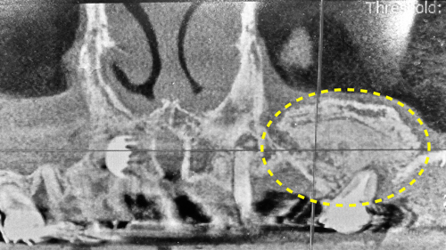 安心　安全　無添加の自己血液由来　フィブリノーゲン