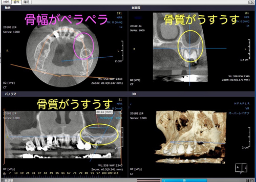 東大阪　インプラント　静脈麻酔鎮静法付き　