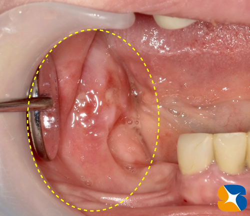 親知らず周囲の歯茎が腫れる