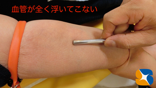 難しい点滴確保