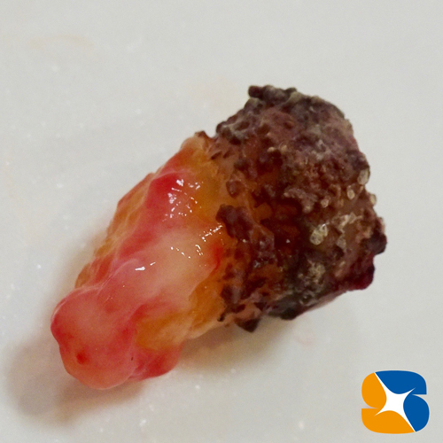 全周歯石で覆われた親知らずの歯