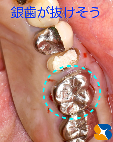 痛くない　怖くない　無料で寝ながらのインプラント　石切　鈴木歯科