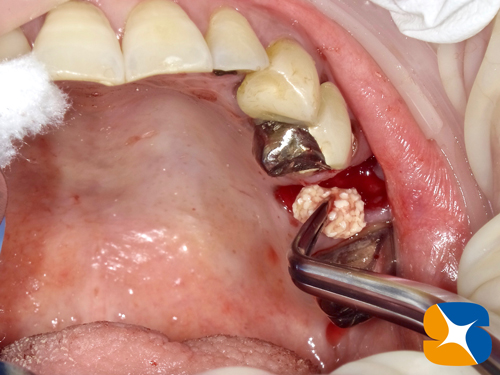 痛くない　怖くない　無料で寝ながらのインプラント　石切　鈴木歯科