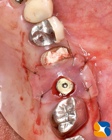 痛くない　怖くない　無料で寝ながらのインプラント　石切　鈴木歯科