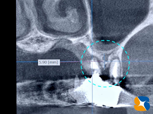抜歯とインプラントを同時