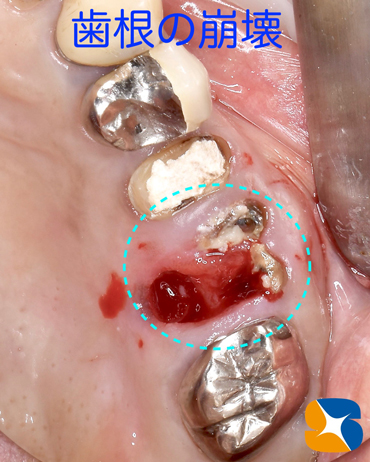 痛くない　怖くない　無料で寝ながらのインプラント　石切　鈴木歯科　最先端歯科医療