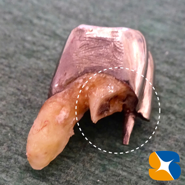 痛くない　怖くない　無料で寝ながらのインプラント　石切　鈴木歯科