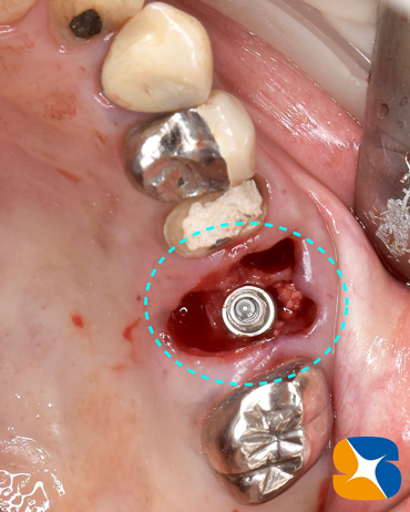 痛くない　怖くない　無料で寝ながらのインプラント　石切　鈴木歯科