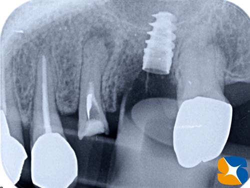 痛くない　怖くない　無料で寝ながらのインプラント　石切　鈴木歯科