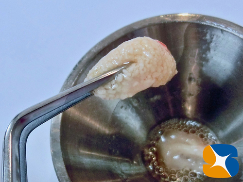 痛くない　怖くない　無料で寝ながらのインプラント　石切　鈴木歯科