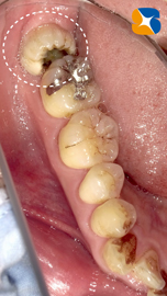 奈良市　親知らず　抜歯　寝ながら無痛