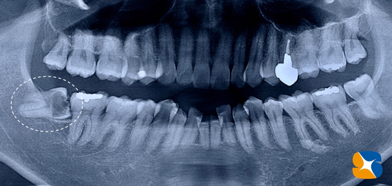 奈良市　親知らず　抜歯　寝ながら無痛