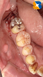 奈良市　親知らず　抜歯　寝ながら無痛