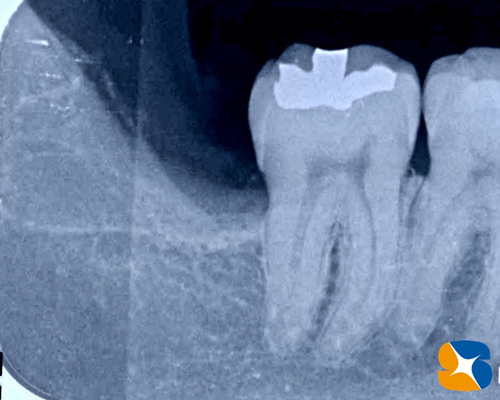 奈良市　親知らず　抜歯　寝ながら無痛