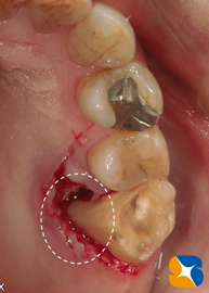 歯を２つに割って残りを残す
