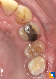 大阪　インプラント　点滴無料　再生医療　ウトウトしながら怖くない　