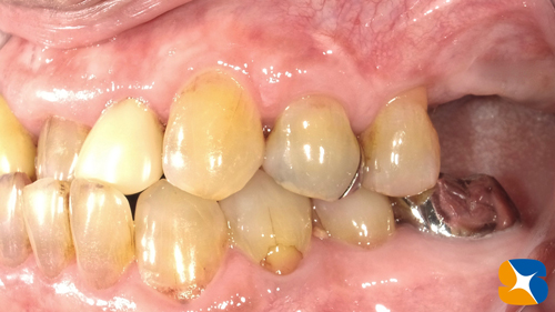 大阪　インプラント　点滴無料　再生医療　ウトウトしながら怖くない