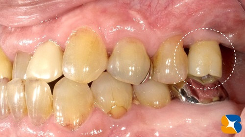 大阪　インプラント　点滴無料　再生医療　ウトウトしながら怖くない