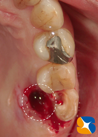 歯を２つに割って残りを残す