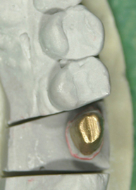 歯を２つに割って残りを残す