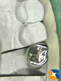 歯を２つに割って残りを残す