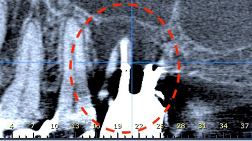 インプラントには厳しい骨の状態