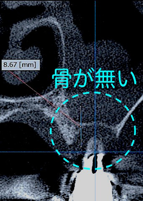 インプラントには厳しい骨の状態