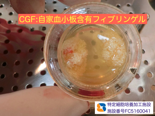 大阪　インプラント　点滴無料　骨の再生医療　インプラント