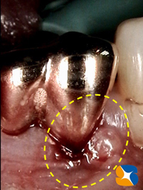 奈良　生駒　石切　大阪　痛くない怖くない再生医療インプラント