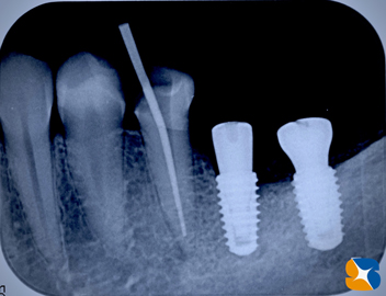 インプラント抜ける　確実なやり直し　インプラント再生医