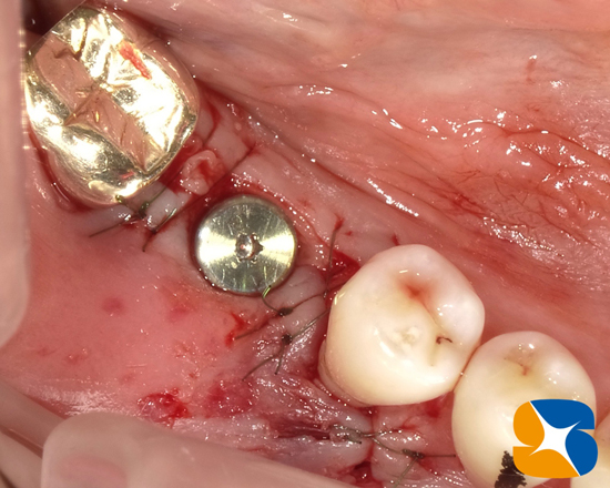 奈良　生駒　石切　大阪　痛くない怖くない再生医療インプラント