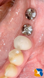 インプラント抜ける　確実なやり直し　インプラント再生医　生駒・奈良・大阪