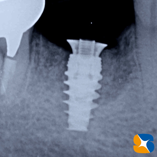 奈良　生駒　石切　大阪　痛くない怖くない再生医療インプラント