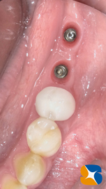 インプラント抜ける　確実なやり直し　インプラント再生医　生駒・奈良・大阪