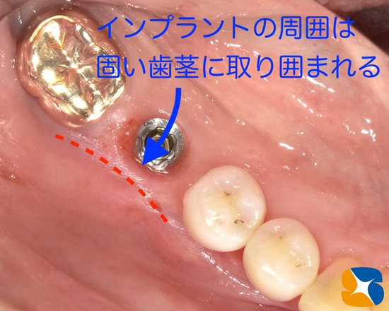 奈良　生駒　石切　大阪　痛くない怖くない再生医療インプラント