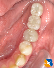 インプラント抜ける　確実なやり直し　インプラント再生医　生駒・奈良・大阪