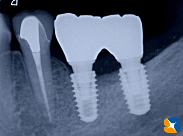 インプラント抜ける　確実なやり直し　インプラント再生医　生駒・奈良・大阪