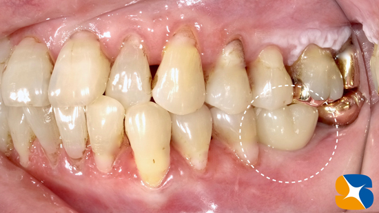 奈良　生駒　石切　大阪　痛くない怖くない再生医療インプラント