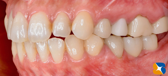 インプラント抜ける　確実なやり直し　インプラント再生医　生駒・奈良・大阪