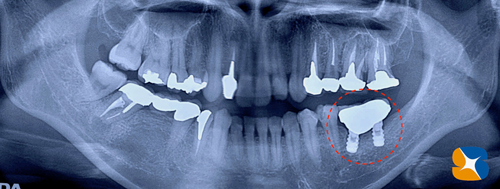 インプラント抜ける　確実なやり直し　インプラント再生医