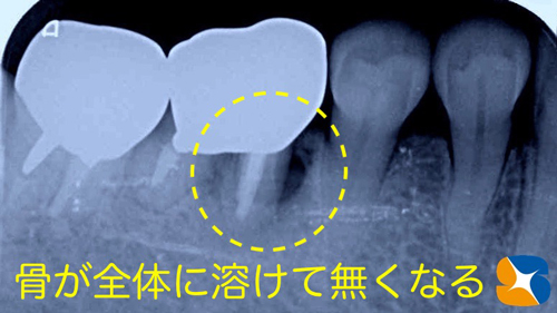 奈良　生駒　石切　大阪　痛くない怖くない再生医療インプラント
