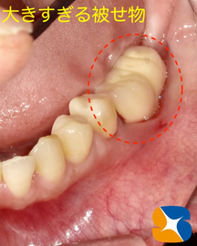 インプラント　再生療法　最先端　大阪・生駒・奈良