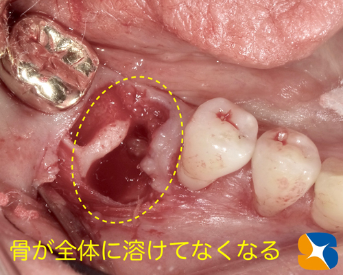 奈良　生駒　石切　大阪　痛くない怖くない再生医療インプラント