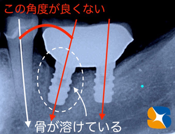 インプラント　再生療法　最先端　大阪・生駒・奈良
