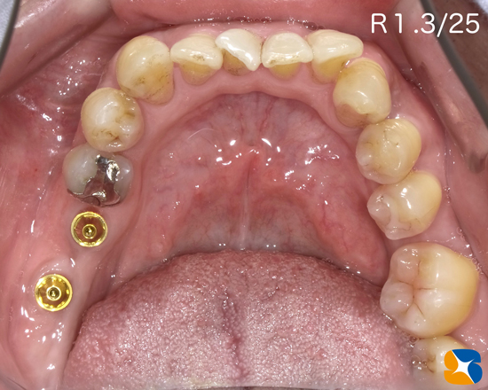 痛くない怖くない安心安全インプラント　静脈麻酔　再生療法　奈良・生駒・東大阪