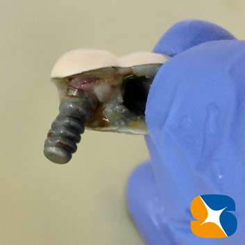 インプラント抜ける　確実なやり直し　インプラント再生医　生駒・奈良・大阪