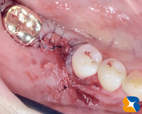 奈良　生駒　石切　大阪　痛くない怖くない再生医療インプラント