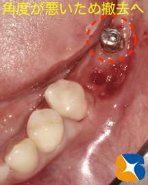 インプラント抜ける　確実なやり直し　インプラント再生医